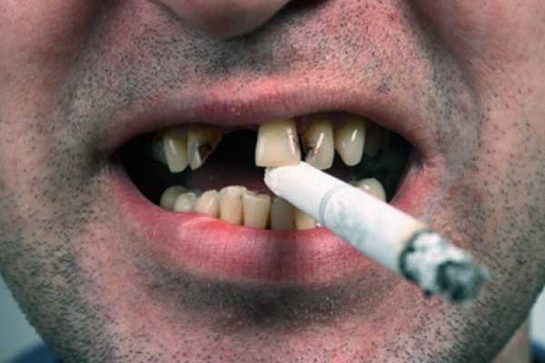 تأثير التدخين على صحة الفم والأسنان