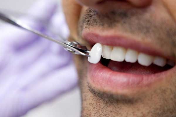 الاسنان التجميلية - أنواعها و أسعارها ومميزات وعيوب كل نوع