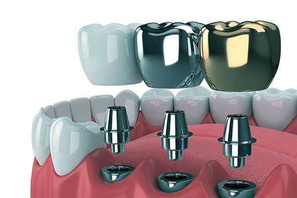 تركيب الأسنان الاصطناعية