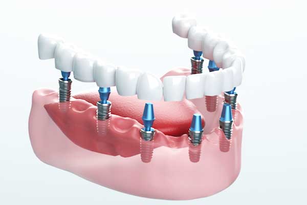 10 Benefits of Getting Dental Implants in Turkey: Positive Changes for Your Smile