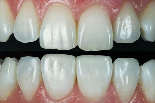 Transform Your Smile with Composite Bonding Turkey: A Complete Guide