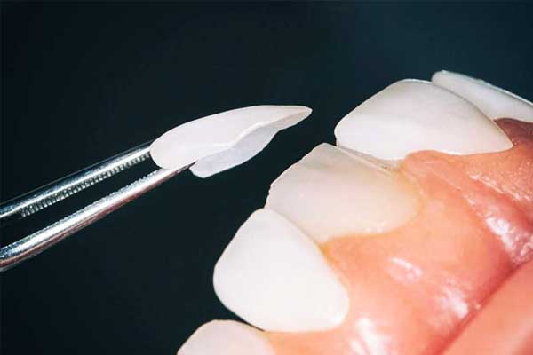 Revitalize Your Smile: Comprehensive Guide to Dental Veneers Turkey