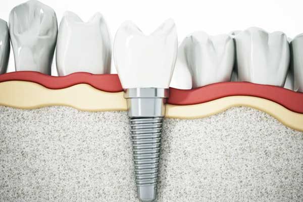 Implantes Dentales en Estambul: La Guía Definitiva para una Sonrisa Perfecta