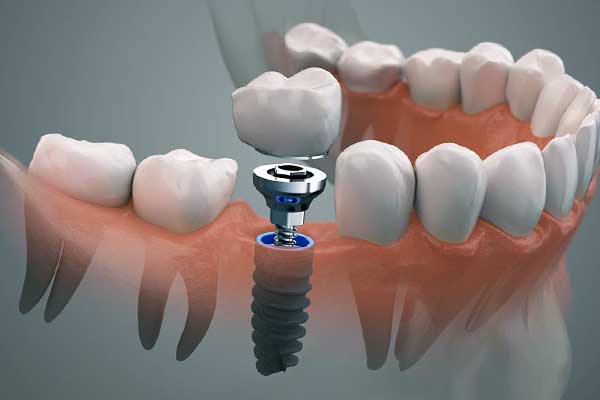 implantes dentales en turquía opiniones y Experiencias de Pacientes