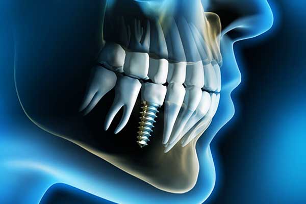 Implantes Dentales en Turquía Precios, Beneficios y Todo lo que Necesitas Saber