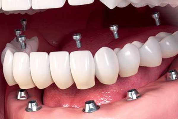 implantes dentales turquía precio: Calidad y Precio Asequible para una Sonrisa Perfecta