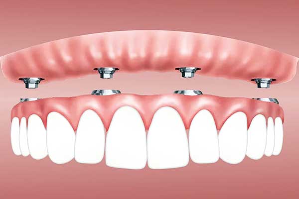 Implantes Dentales Turquía: Calidad y Asequibilidad a Tu Alcance