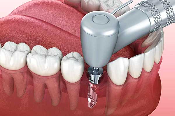 Precio de Implantes Dentales en Estambul: Calidad y Ahorro para una Sonrisa Perfecta