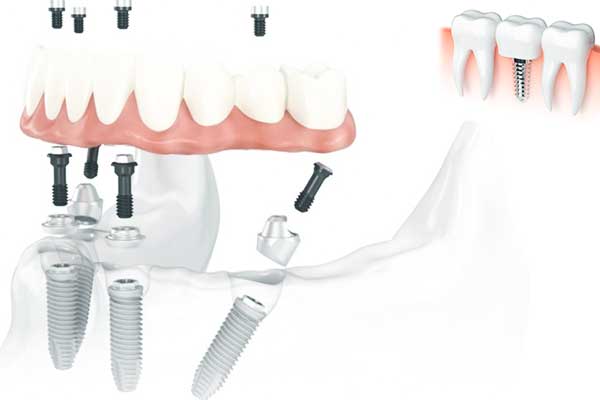 Precio Implantes Dentales para Toda la Boca en Turquía: Una Sonrisa Completa y Asequible