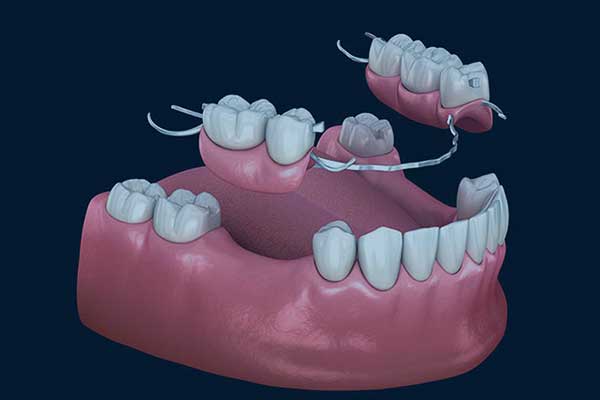 Puente Dental en Turquía: La Solución Definitiva para una Sonrisa Completa y Saludable