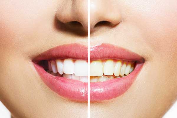 Achieve a Radiant Smile: Teeth Whitening in Turkey