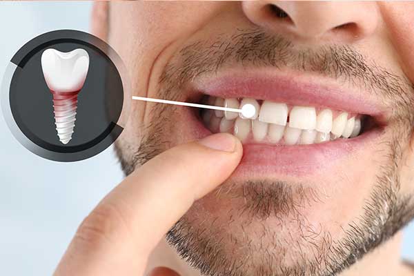 ¿Cuánto cuestan los implantes dentales en Turquía en 2024?