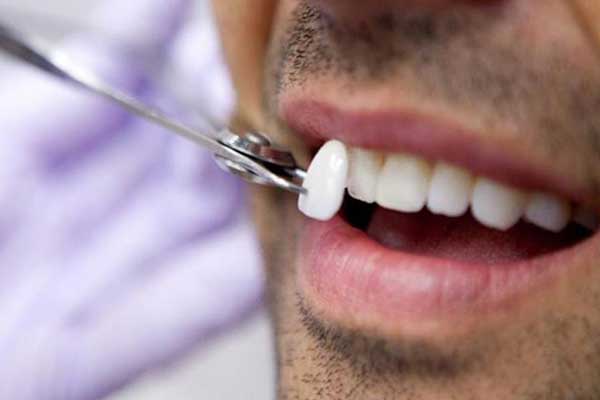 ¿Cuánto Cuestan las Carillas Dentales en Turquía? ¡Descubre Todo lo Que Necesitas Saber!