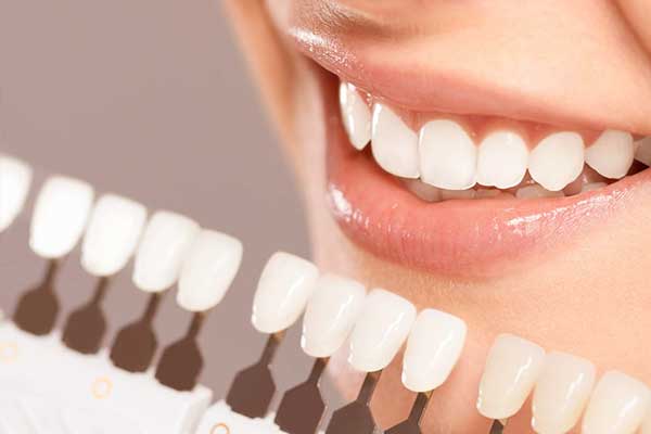 Faccette dentali Emax costo: Quanto Costano e Quali Sono i Vantaggi?