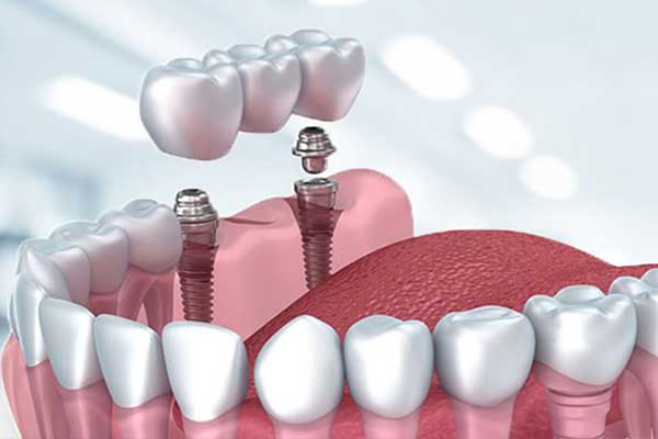 ¿Cuál es el Costo de un Implante Dental? Guía Completa para 2024