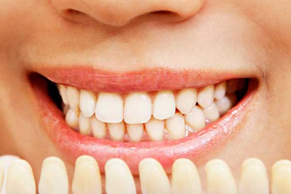 Rifarsi i Denti in Turchia Prezzi e Guida Completa per un Sorriso Perfetto