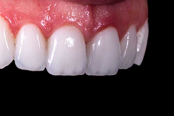 Pacchetto Faccette Dentali Turchia: Tutto Quello che Devi Sapere