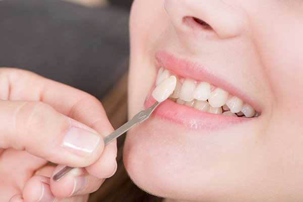 How Long Do You Need to Stay in Turkey for Veneers? Your Complete Guide