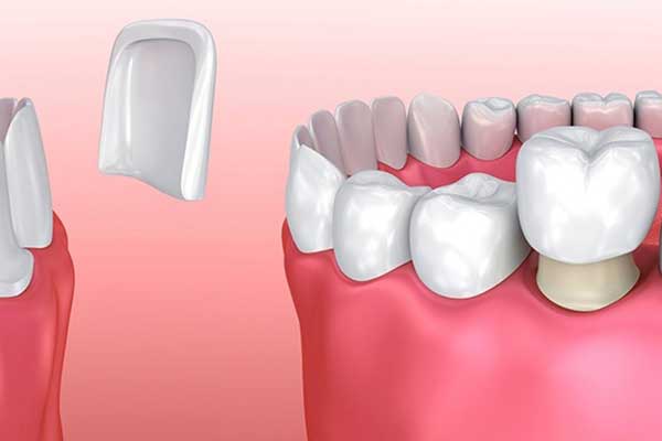 How Much Is a Full Mouth of Veneers in Turkey? A Comprehensive Guide