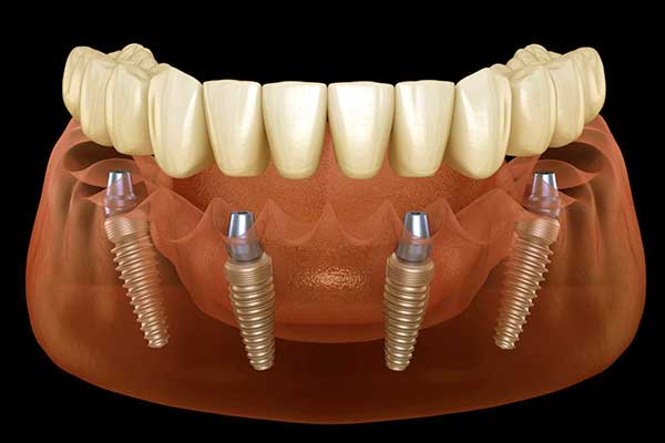 ¿Cuánto Tiempo Duran los Implantes Dentales? ¡Descúbrelo Aquí!