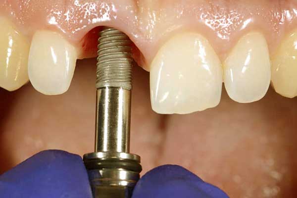 ¿Cuánto Cuesta Ponerse Implantes en los Dientes?