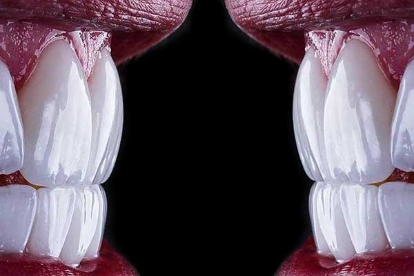 ¿Cómo Quedan los Dientes Cuando Te Pones Carillas? Todo Lo Que Debes Saber