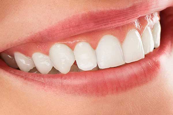 Quanto Durano le Faccette Dentali? Scopri la Verità e i Segreti di un Sorriso Perfetto