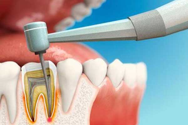 Chirurgia Dentale Turchia: Guida Completa per un Sorriso Perfetto