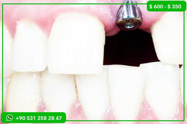 Dental Implant Prices in Saudi Arabia vs Turkey: 7 Reasons to Choose Turkey