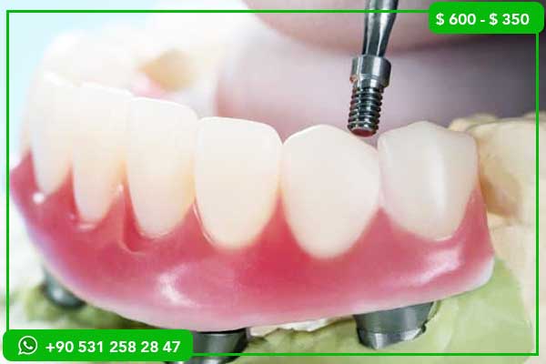 Precios de Implantes Dentales en Siria vs. Turquía – ¿Cuál es la Mejor Opción?