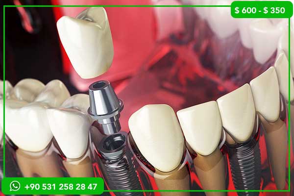 Precios de Implantes Dentales en Líbano vs Turquía – 7 Razones por las que Turquía es la Mejor Opción