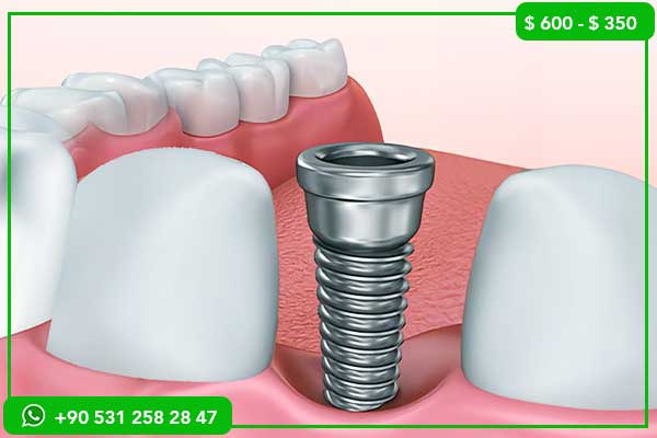 Precios de implantes dentales en Palestina vs Turquía – ¿Por qué elegir Turquía?