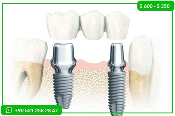 Precios de Implantes Dentales en Egipto vs. Turquía – ¿Por Qué Elegir Turquía?