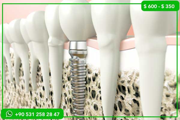 Precios de implantes dentales en Sudán vs. Turquía – ¿Por qué elegir Turquía?