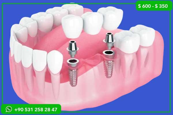 Precios de Implantes Dentales en Libia vs. Turquía – 7 Razones para Elegir Turquía