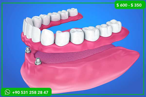 Dental Implant Prices in Tunisia vs Turkey – Why Choose Turkey?