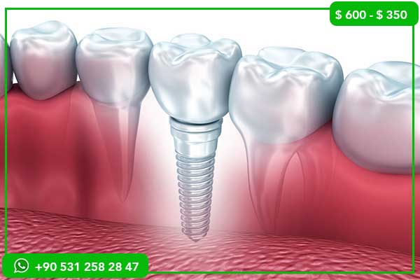 أسعار زراعة الأسنان في الجزائر مقابل تركيا – 7 أسباب تجعل تركيا الخيار الأفضل!