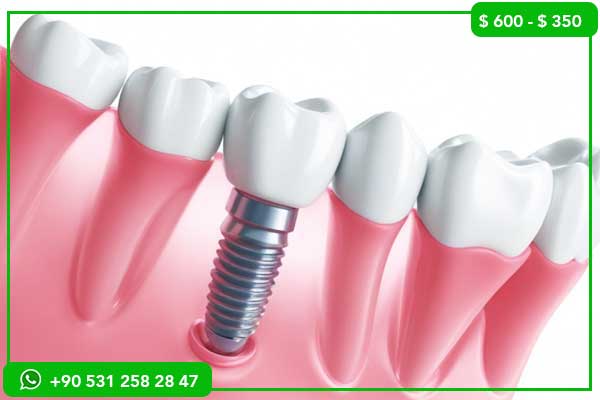 Precios de Implantes Dentales en Marruecos vs Turquía – ¿Por Qué Elegir Turquía?