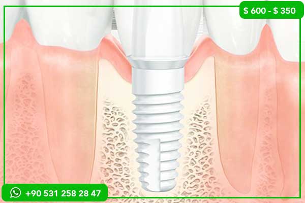 Precios de Implantes Dentales en EAU vs Turquía – 7 Razones para Elegir Turquía