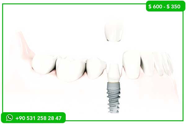 Precios de implantes dentales en Somalia vs. Turquía – 7 razones para elegir Turquía