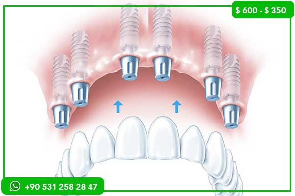 Precios de Implantes Dentales en Yibuti vs. Turquía – ¡7 Razones para Elegir Turquía!