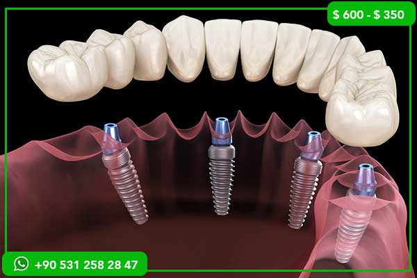 Precios de Implantes Dentales en Comoras vs Turquía – ¡7 Razones para Elegir Turquía!