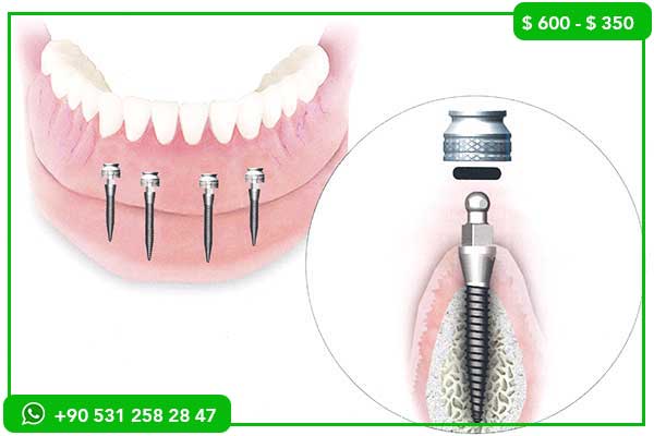 Prezzi degli impianti dentali in Francia vs Turchia – 7 motivi per scegliere la Turchia