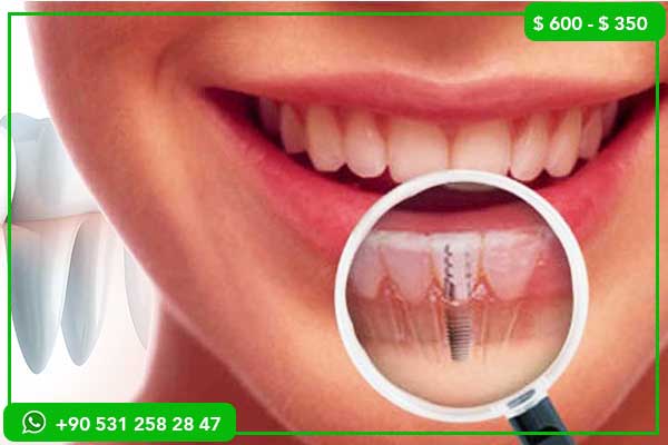 Dental Implants, Dental Implant Cost, Dental Implants Turkey, Dental Implants Germany, Dental Implant Prices, Affordable Dental Implants, Dental Tourism Turkey, Germany vs Turkey Dental Implants, Best Dental Implants, Dental Treatment Abroad, Full Mouth Implants, Dental Clinic Turkey, Dental Care Costs, Cheap Dental Implants, High-Quality Dental Implants