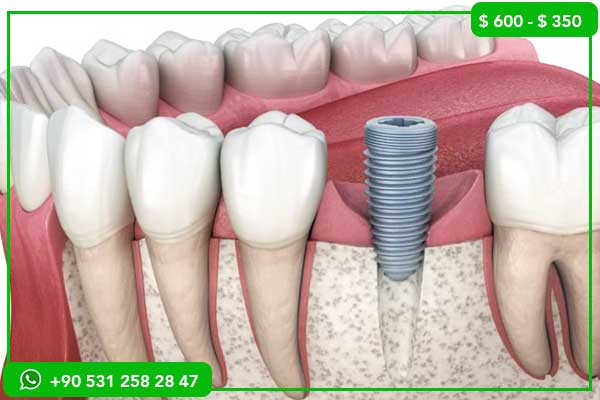 Precios de Implantes Dentales en Bélgica vs. Turquía – 7 Razones para Elegir Turquía