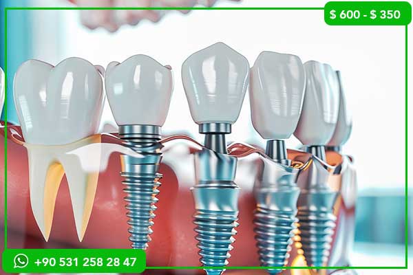 Dental Implant Prices in the Netherlands vs Turkey – Why Choose Turkey?