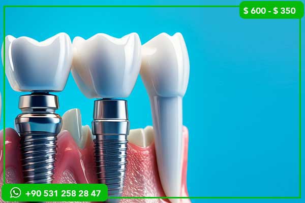 Precios de Implantes Dentales en Luxemburgo vs Turquía – 7 Razones para Elegir Turquía