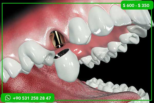 Precios de los implantes dentales en Suiza vs Turquía – ¿Por qué elegir Turquía?