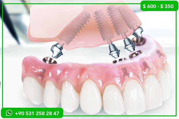 Precios de Implantes Dentales en Austria vs Turquía – 7 Razones para Elegir Turquía