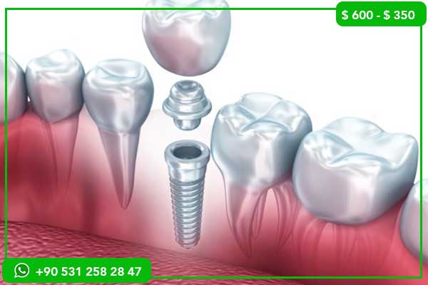 أسعار زراعة الأسنان في قطر مقابل تركيا – 7 أسباب لاختيار تركيا!